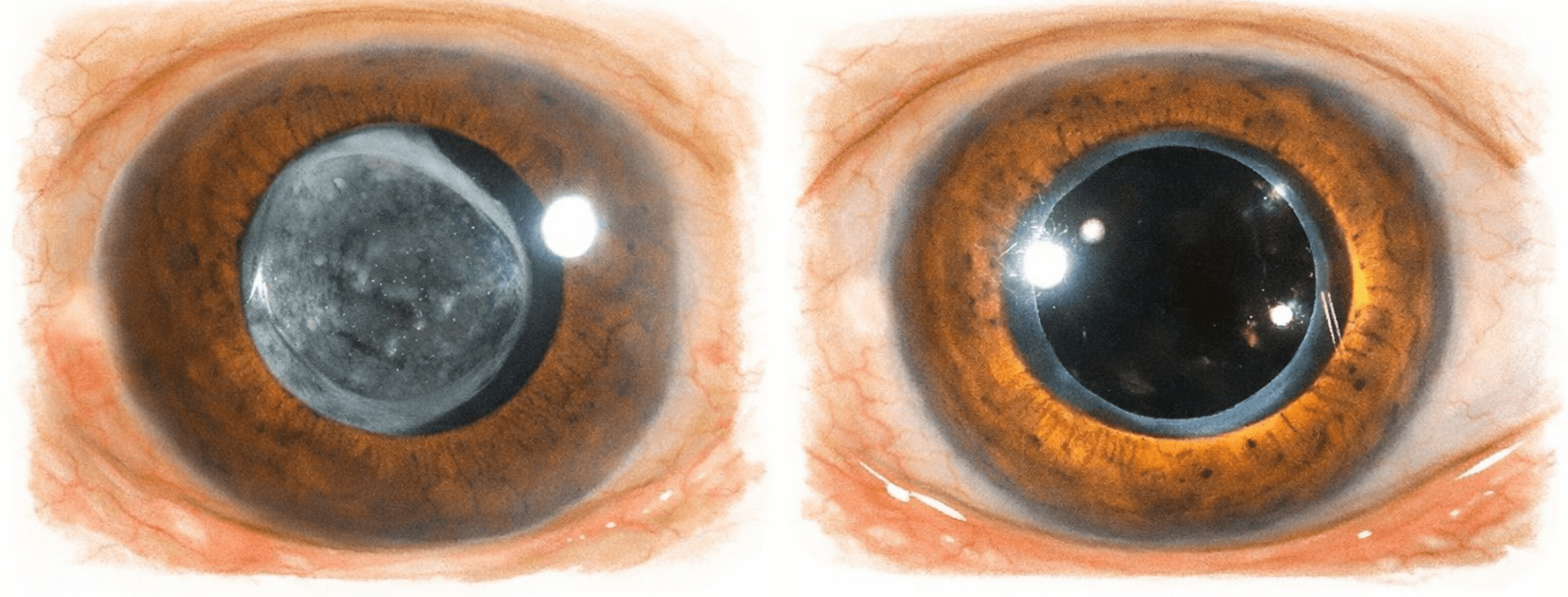 Capsulotomía posterior con láser YAG