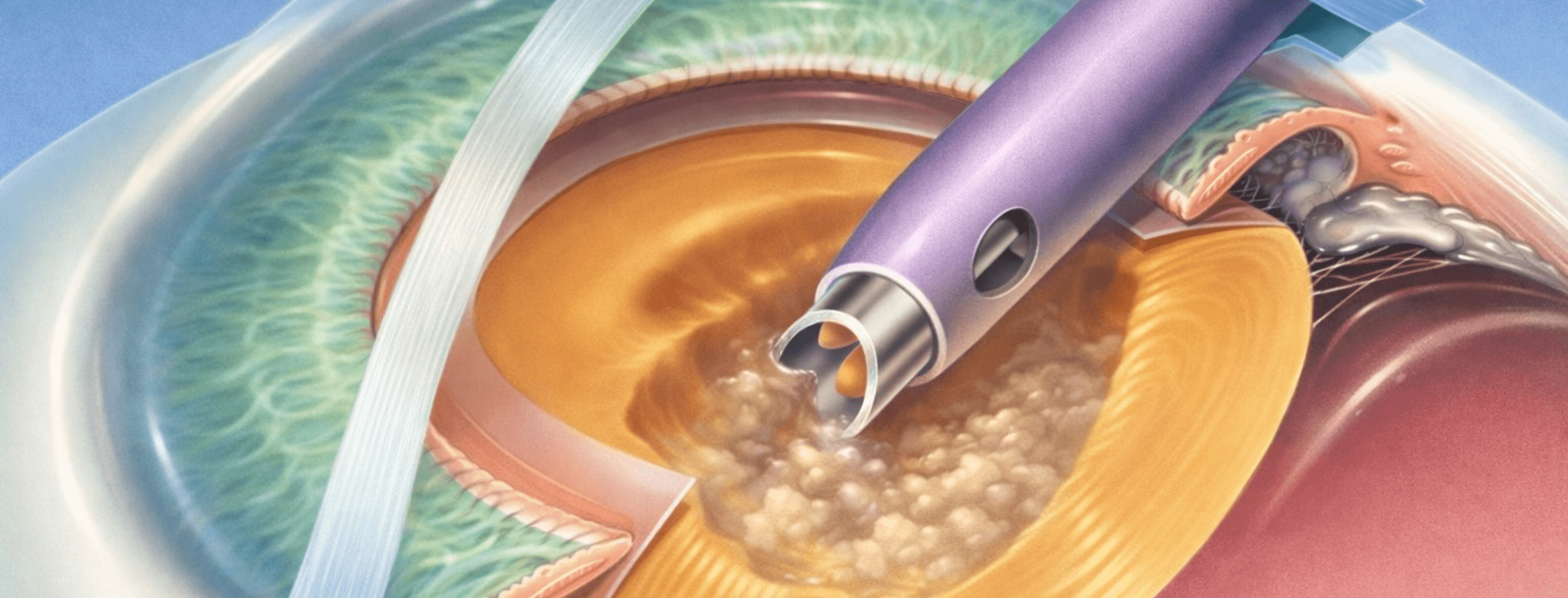 Cirugía de catarata por facoemulsificación