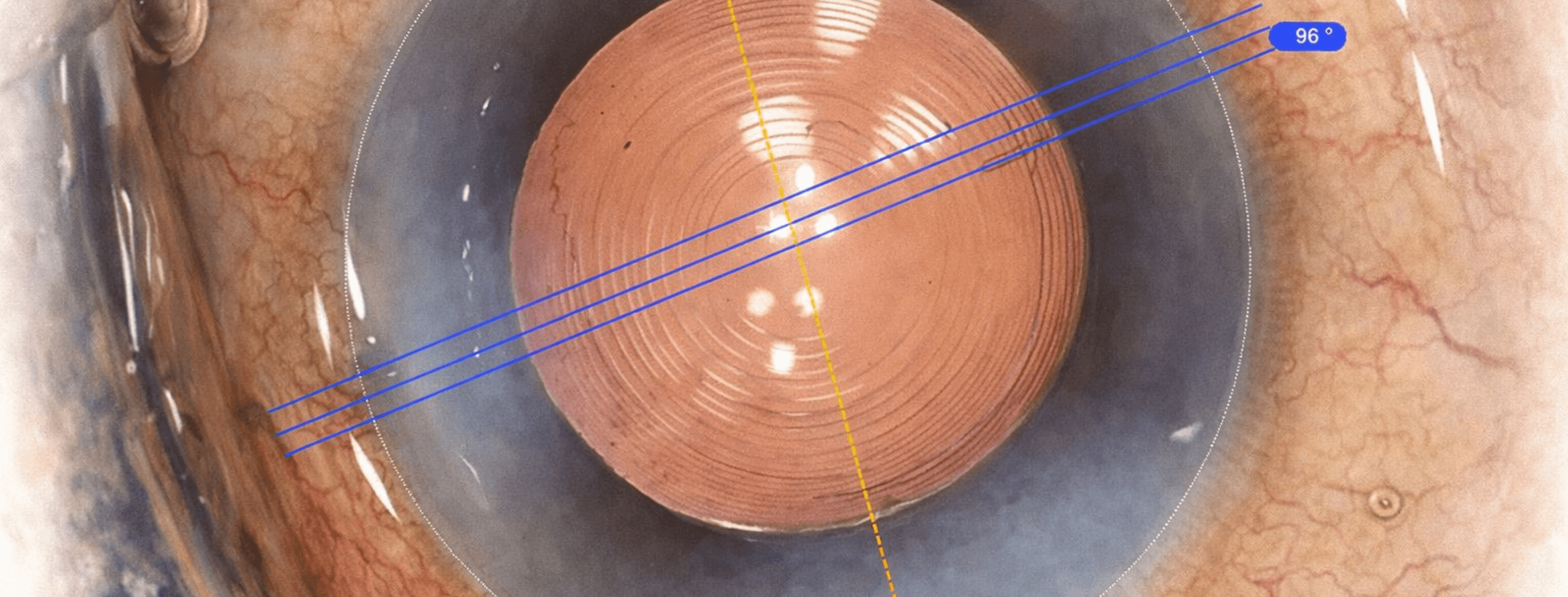 Corrección de astigmatismo en cirugía de catarata